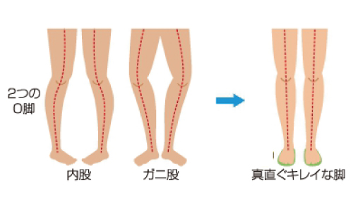 インソールとは？その④