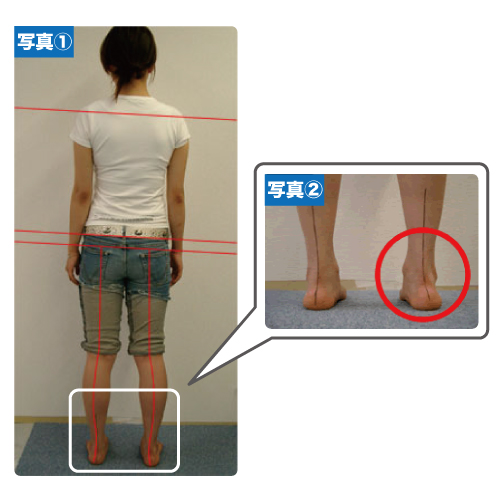 体の歪み実例　その①